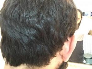 3200-grafts-fue (16)