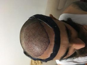 3200-grafts-fue (18)