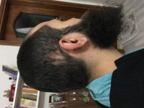 3200-grafts-fue (2)
