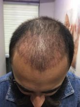 3200-grafts-fue (20)