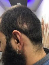 3200-grafts-fue (21)