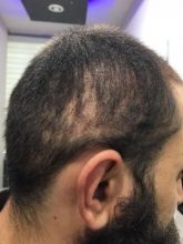 3200-grafts-fue (22)
