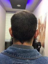 3200-grafts-fue (23)