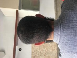3200-grafts-fue (26)