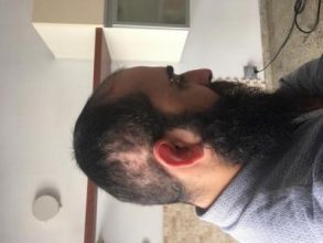3200-grafts-fue (27)