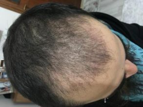 3200-grafts-fue (28)