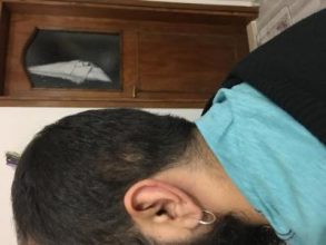 3200-grafts-fue (29)