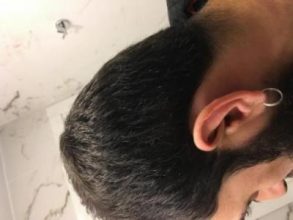 3200-grafts-fue (4)