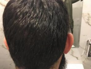 3200-grafts-fue (5)