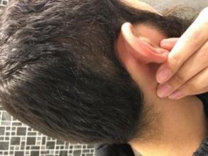 3200-grafts-fue (6)