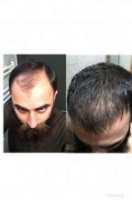 3200-grafts-fue (7)