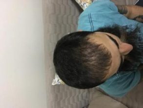 3200-grafts-fue (8)