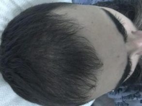 3200-grafts-fue (9)