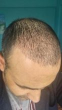 zekeriya-kul-hair-transplant-results (1)