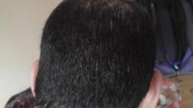 zekeriya-kul-hair-transplant-results (10)