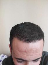 zekeriya-kul-hair-transplant-results (11)