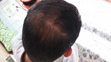 zekeriya-kul-hair-transplant-results (12)