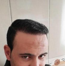 zekeriya-kul-hair-transplant-results (14)