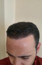 zekeriya-kul-hair-transplant-results (15)