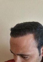 zekeriya-kul-hair-transplant-results (16)