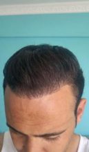 zekeriya-kul-hair-transplant-results (18)
