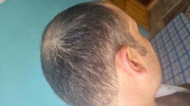 zekeriya-kul-hair-transplant-results (2)