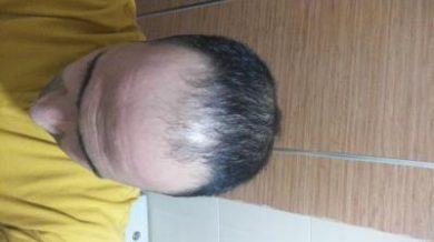 zekeriya-kul-hair-transplant-results (20)