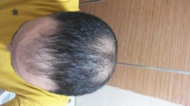 zekeriya-kul-hair-transplant-results (21)