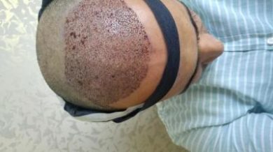 zekeriya-kul-hair-transplant-results (22)