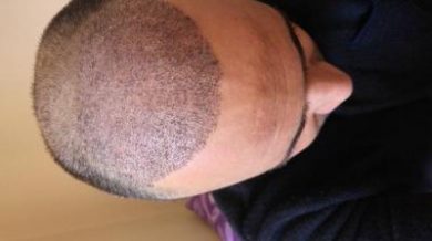 zekeriya-kul-hair-transplant-results (23)