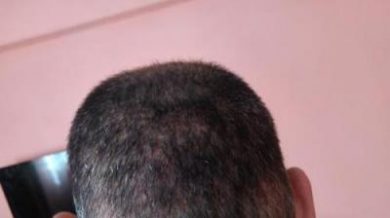 zekeriya-kul-hair-transplant-results (25)