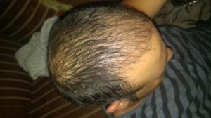 zekeriya-kul-hair-transplant-results (3)
