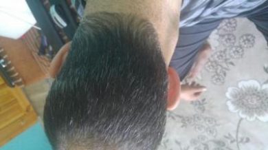 zekeriya-kul-hair-transplant-results (4)