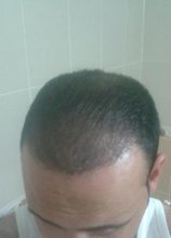 zekeriya-kul-hair-transplant-results (5)