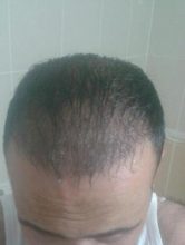 zekeriya-kul-hair-transplant-results (6)