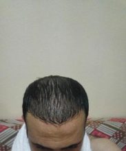 zekeriya-kul-hair-transplant-results (7)