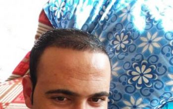 zekeriya-kul-hair-transplant-results (8)