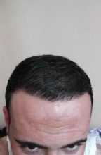 zekeriya-kul-hair-transplant-results (9)