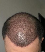dr-koray-erdogan-hair-transplant (10)