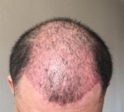 dr-koray-erdogan-hair-transplant (11)