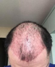dr-koray-erdogan-hair-transplant (12)
