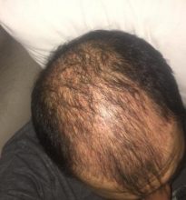 dr-koray-erdogan-hair-transplant (13)