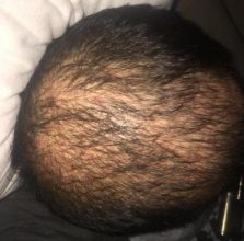 dr-koray-erdogan-hair-transplant (14)
