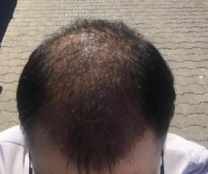 dr-koray-erdogan-hair-transplant (15)