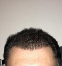 dr-koray-erdogan-hair-transplant (16)