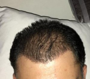 dr-koray-erdogan-hair-transplant (17)