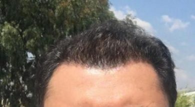 dr-koray-erdogan-hair-transplant (18)