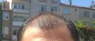 dr-koray-erdogan-hair-transplant (19)