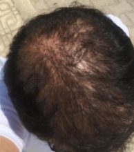 dr-koray-erdogan-hair-transplant (20)