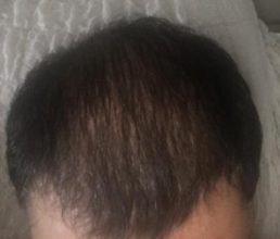 dr-koray-erdogan-hair-transplant (21)